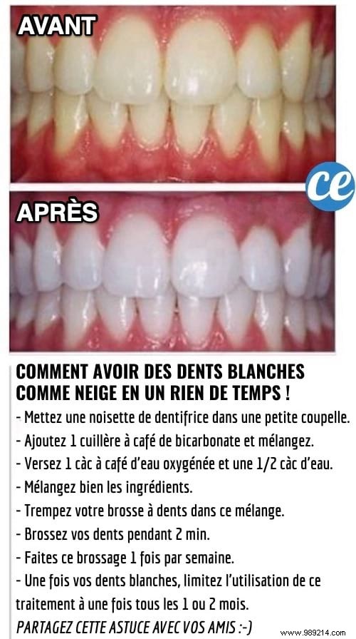 Achieve a Brighter, Snow-White Smile Naturally: My Dentist s Proven Home Remedy