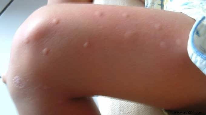 Why Do Mosquitoes Bite Some People More Than Others? 10 Science-Backed Reasons