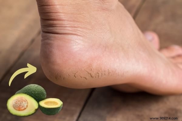 11 Expert Ways to Use Overripe Avocados: Chef-Approved Recipes and Beauty Tips