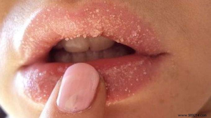 Struggling with Dry, Chapped Lips? 2 Proven Natural Homemade Remedies
