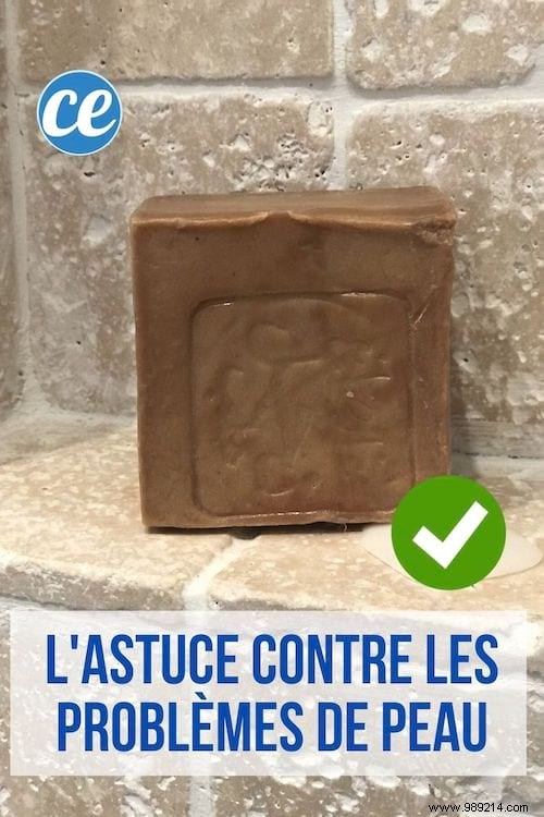 How Authentic Aleppo Soap Clears Acne and Heals Skin: Proven Tips from Experience