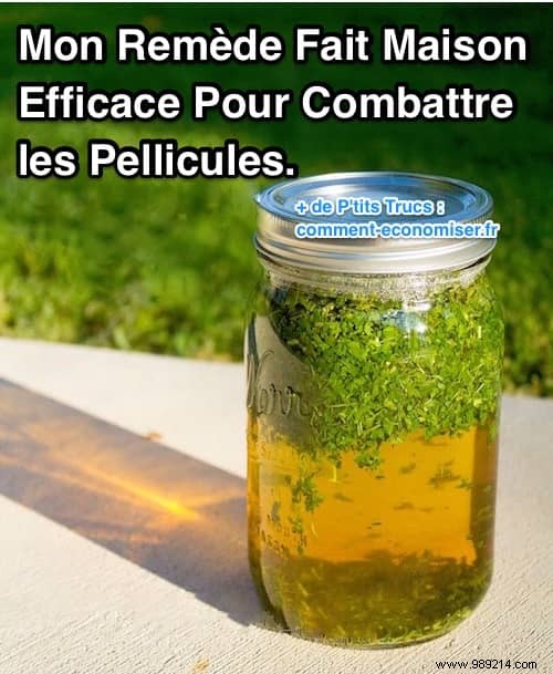 Banish Dandruff Naturally: My Proven Nettle Lotion Home Remedy