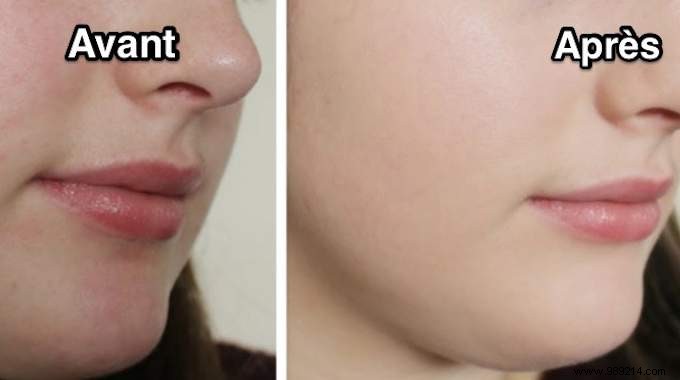 3 Proven Natural Tips to Soothe Winter Skin Redness on Face, Baby s Skin, and Hands