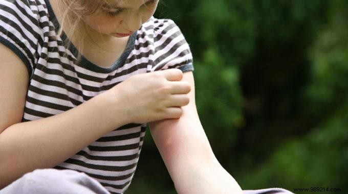 6 Proven Natural Remedies for Mosquito Bites: Fast, Effective Relief at Home