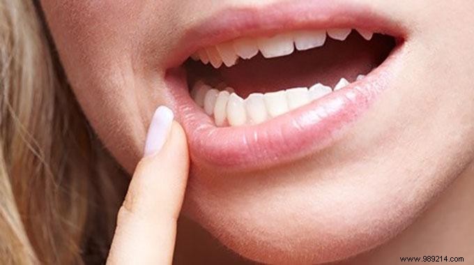Fast Mouth Ulcer Relief: Proven Salt Water Rinse Remedy