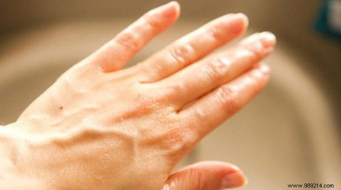 Soften Dry Hands Naturally in 2 Minutes: Simple Vinegar and Sugar Scrub