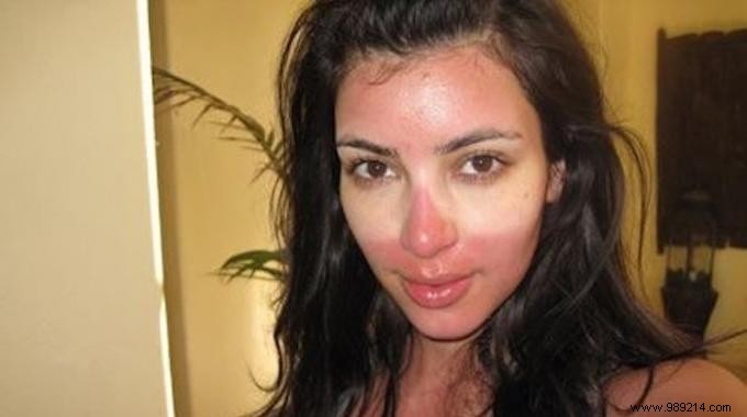 Soothe Sunburn Pain Naturally: Aloe Vera Ice Cubes for Fast Relief