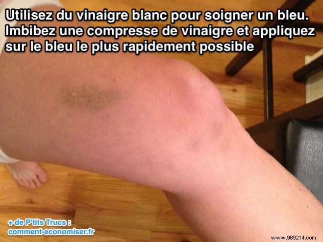 Heal Hematomas Quickly: Time-Tested White Vinegar Remedy