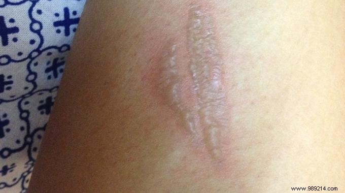 Soothe Minor Burns Quickly: The Effective Fluoride Toothpaste Remedy