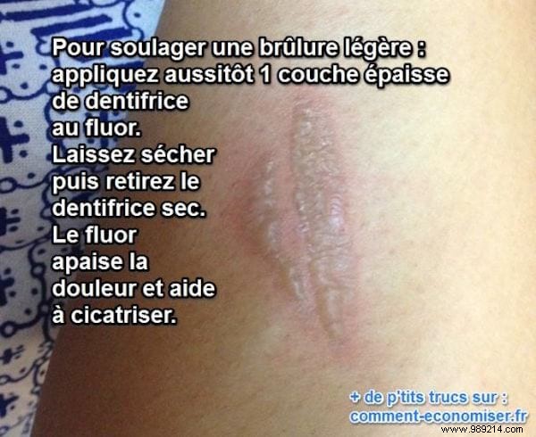 Soothe Minor Burns Quickly: The Effective Fluoride Toothpaste Remedy