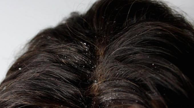 Effective White Vinegar Remedy: Banish Dandruff Naturally