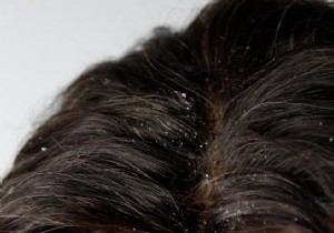 Effective White Vinegar Remedy: Banish Dandruff Naturally