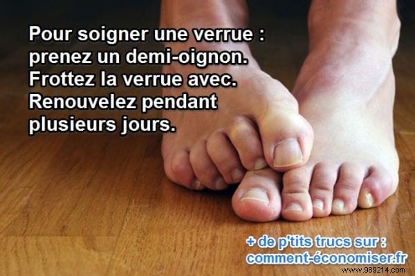 Natural Wart Removal: A Traditional Onion Remedy Backed by Folk Wisdom