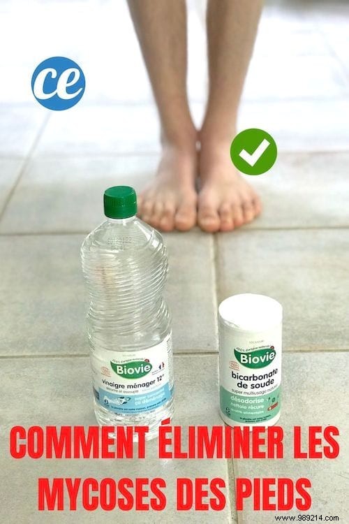 How to Effectively Eliminate Nail Fungus: Proven Home Remedies