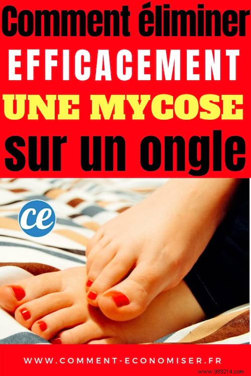 How to Effectively Eliminate Nail Fungus: Proven Home Remedies