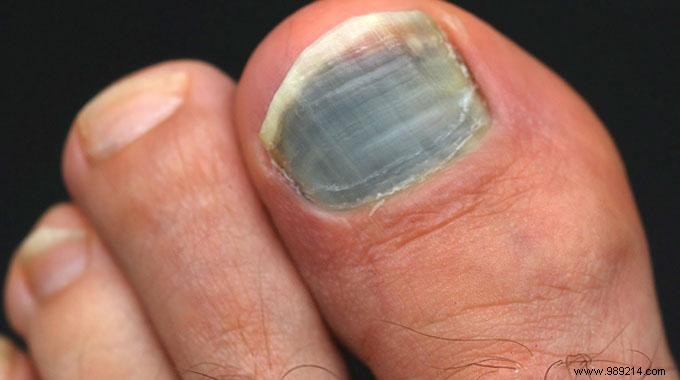 How to Safely Treat a Black Toenail: Expert Drainage Technique