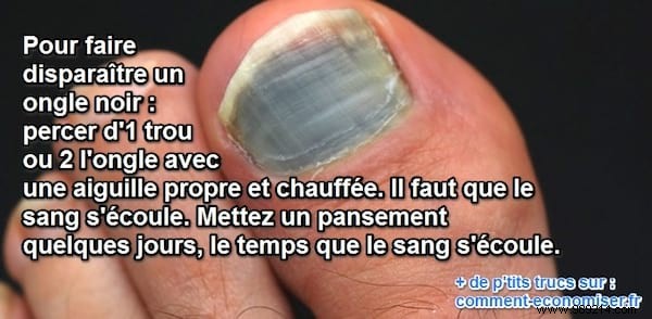 How to Safely Treat a Black Toenail: Expert Drainage Technique