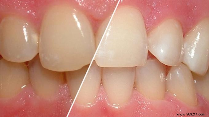 Prevent Teeth Yellowing Naturally: Proven Diluted White Vinegar Method