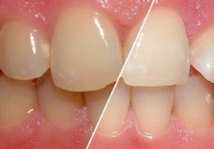 Prevent Teeth Yellowing Naturally: Proven Diluted White Vinegar Method