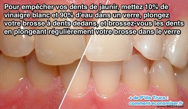 Prevent Teeth Yellowing Naturally: Proven Diluted White Vinegar Method