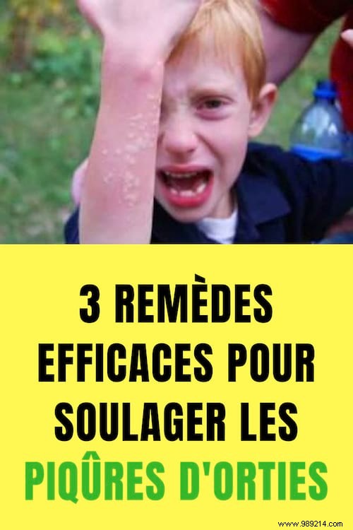 3 Proven Natural Remedies to Soothe Stinging Nettle Stings