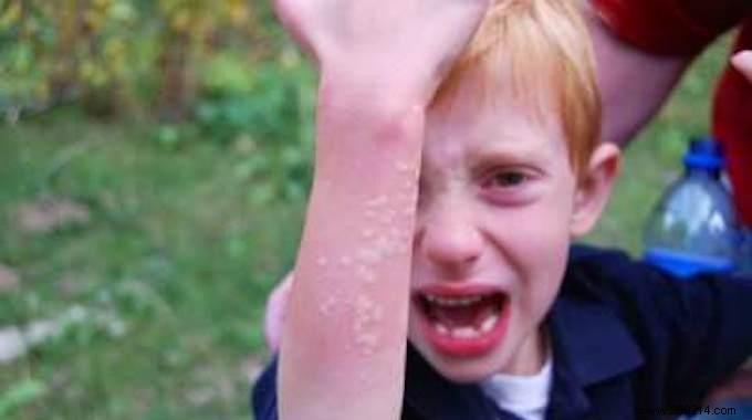 3 Proven Natural Remedies to Soothe Stinging Nettle Stings