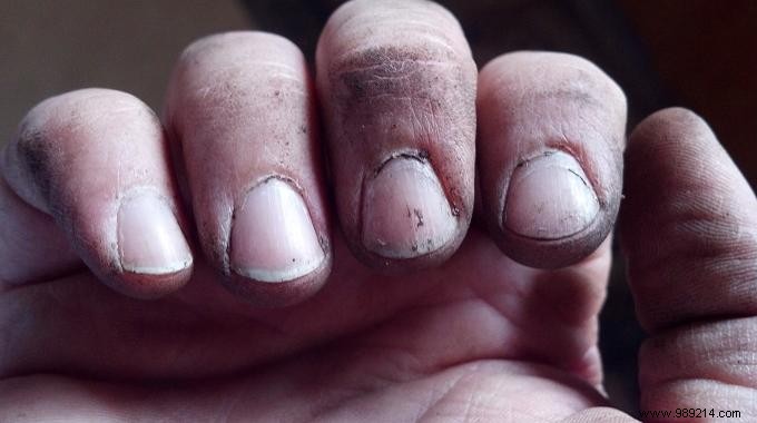 How to Easily Clean Dirt from Under Your Nails with Hydrogen Peroxide