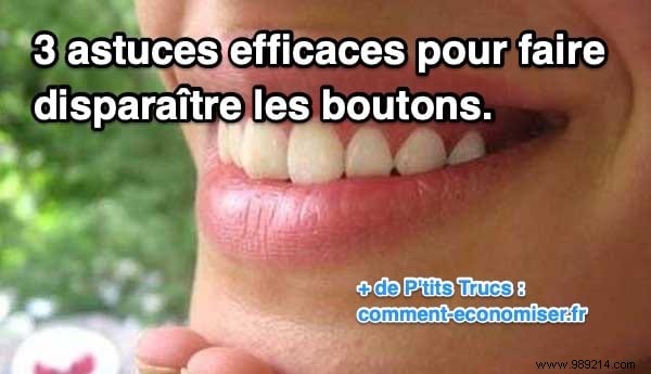 3 Proven Natural Remedies to Banish Unsightly Pimples Overnight