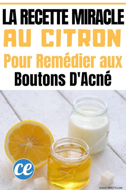 My Proven Lemon and Sour Milk Recipe: A Natural Way to Clear Acne Pimples