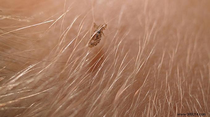 4 Proven Teacher Tips to Eliminate Head Lice Naturally