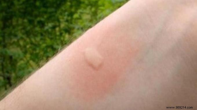 Soothe Itchy Mosquito Bites Fast: The Banana Peel Remedy