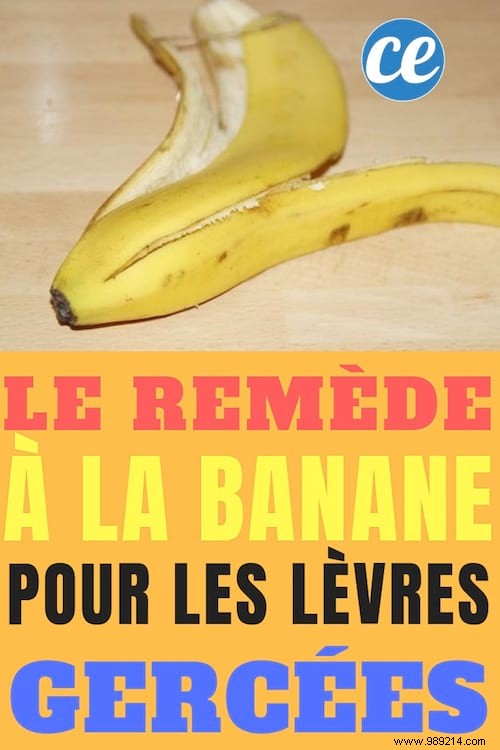 Heal Dry, Chapped Lips Naturally: My Proven Banana Remedy