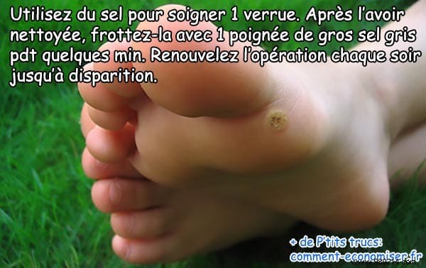 Effective Natural Wart Removal: Time-Tested Salt Remedy