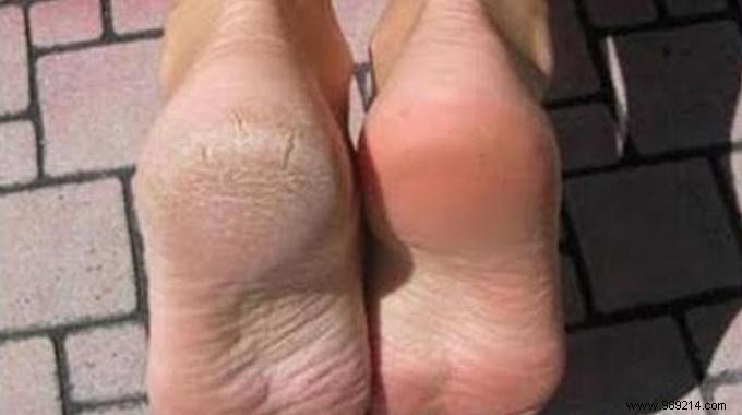 Revitalize Dry, Cracked Feet with Sweet Almond Oil Massage