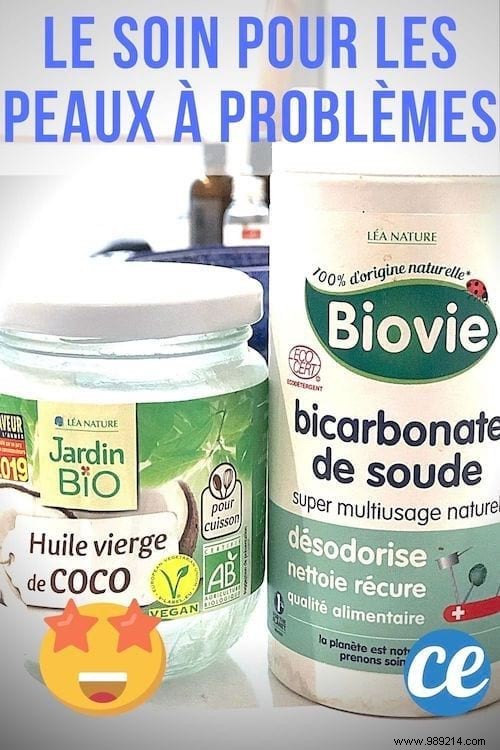 Baking Soda and Coconut Oil: A Natural, Effective Cleanser for Acne-Prone and Sensitive Skin
