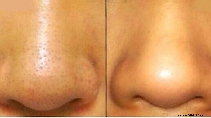 Effective Natural Blackhead Removal: Lemon and Baking Soda Remedy