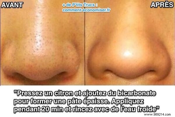 Effective Natural Blackhead Removal: Lemon and Baking Soda Remedy