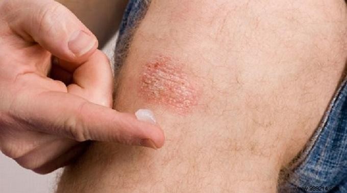 7 Proven Natural Remedies to Soothe Psoriasis Symptoms