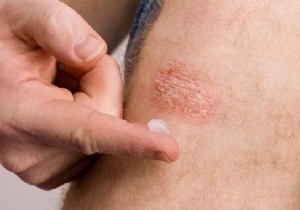 7 Proven Natural Remedies to Soothe Psoriasis Symptoms