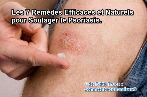 7 Proven Natural Remedies to Soothe Psoriasis Symptoms