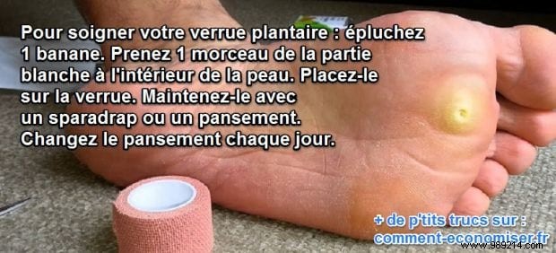 Effective Banana Peel Remedy for Plantar Warts: A Simple Natural Treatment