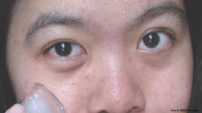 Quick Natural Fix: Reduce Under-Eye Bags with Ice Cubes