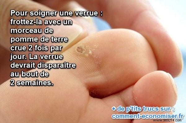 Remove Warts Naturally with Potatoes: A Simple, Proven Home Remedy