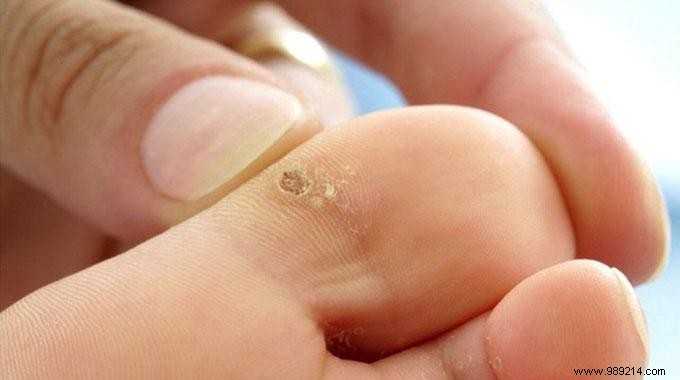 Remove Warts Naturally with Potatoes: A Simple, Proven Home Remedy