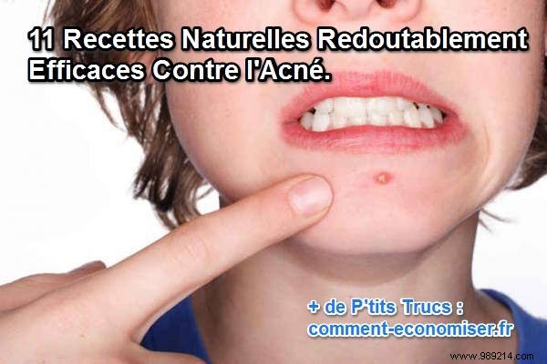 11 Proven Natural Remedies to Effectively Combat Acne