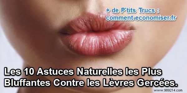 10 Proven Natural Remedies for Chapped Lips: Soothe, Hydrate, and Heal Naturally