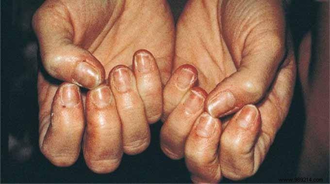 Strengthen Brittle Nails: The Proven Salt Water Soak Method