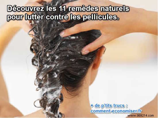 11 Proven Natural Remedies to Banish Dandruff for Good