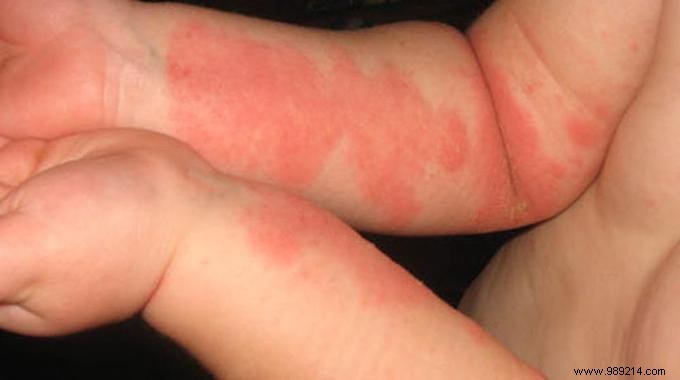 Effective Tips to Relieve Eczema Itching: Practical Advice from Real Experience
