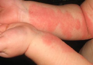 Effective Tips to Relieve Eczema Itching: Practical Advice from Real Experience